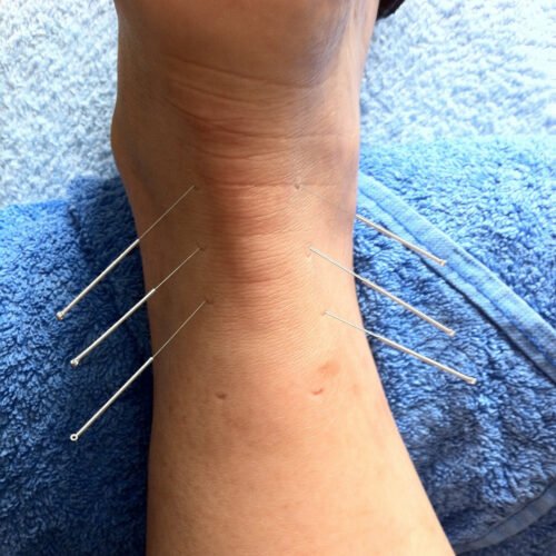 Dry Needling Performed on Ankle