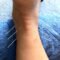 Dry Needling Performed on Ankle