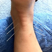Dry needling on ankle