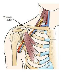 A representation of someone experiencing Thoracic Outlet Syndrome