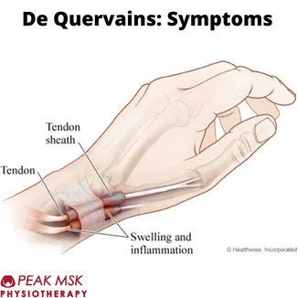 De Quervain’s tenosynovitis