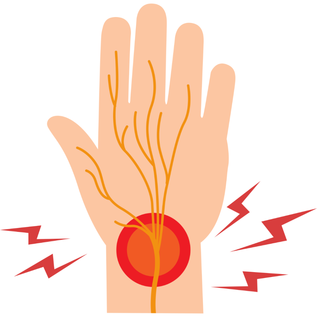 carpal tunnel syndrome