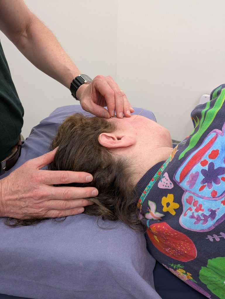 jaw needling photo